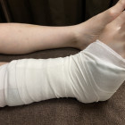 骨折時の悩みについて